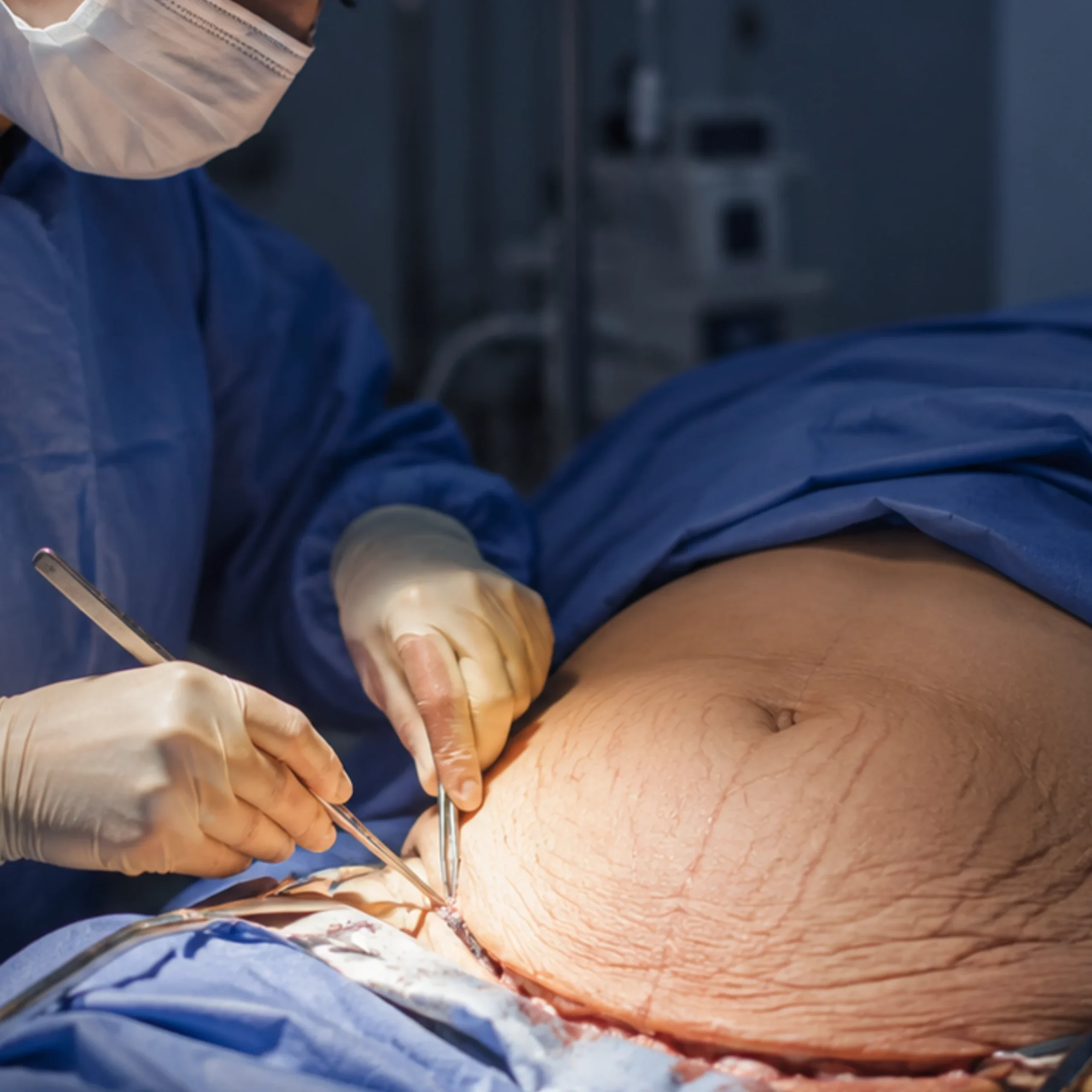 Abdominoplastia y cirugía estética abdominal
