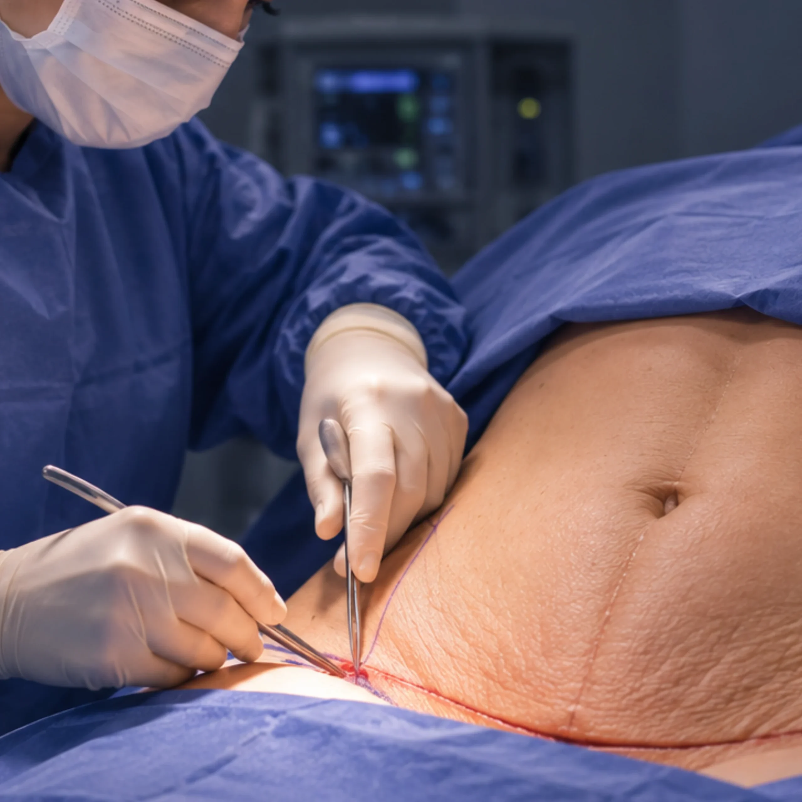 Minidermolipectomía para tratar exceso de piel en abdomen bajo